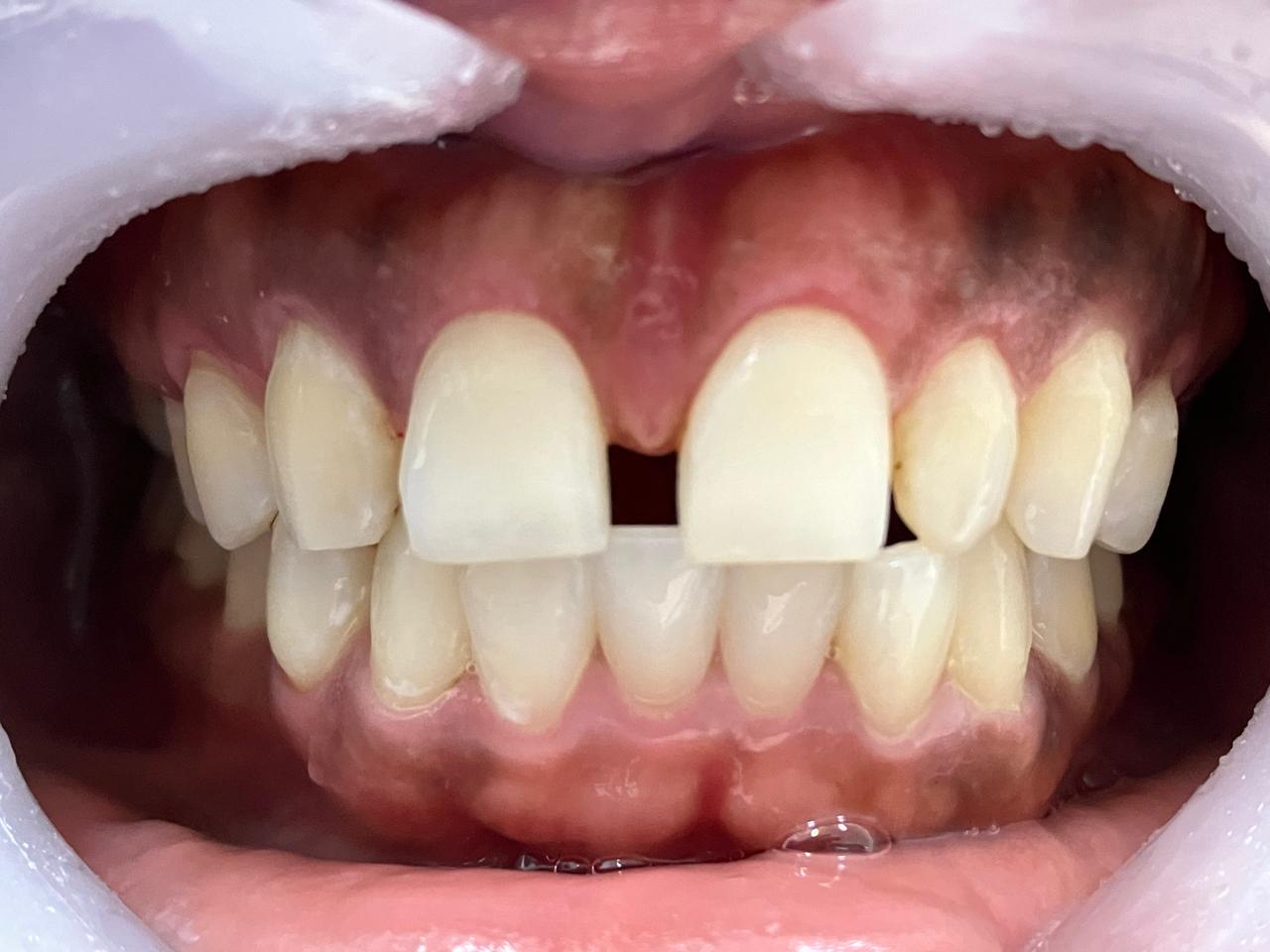 Foto clínica antes del tratamiento: espacio entre los dientes