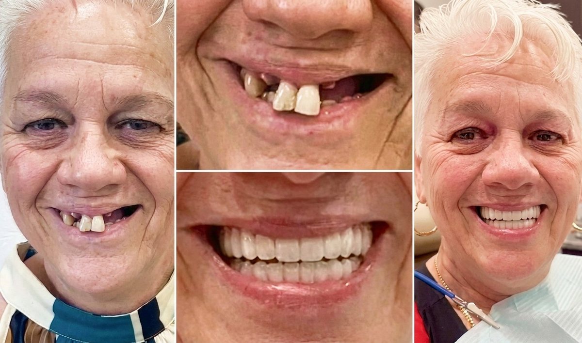 Antes y después: paciente que recuperó su sonrisa completa con implantes