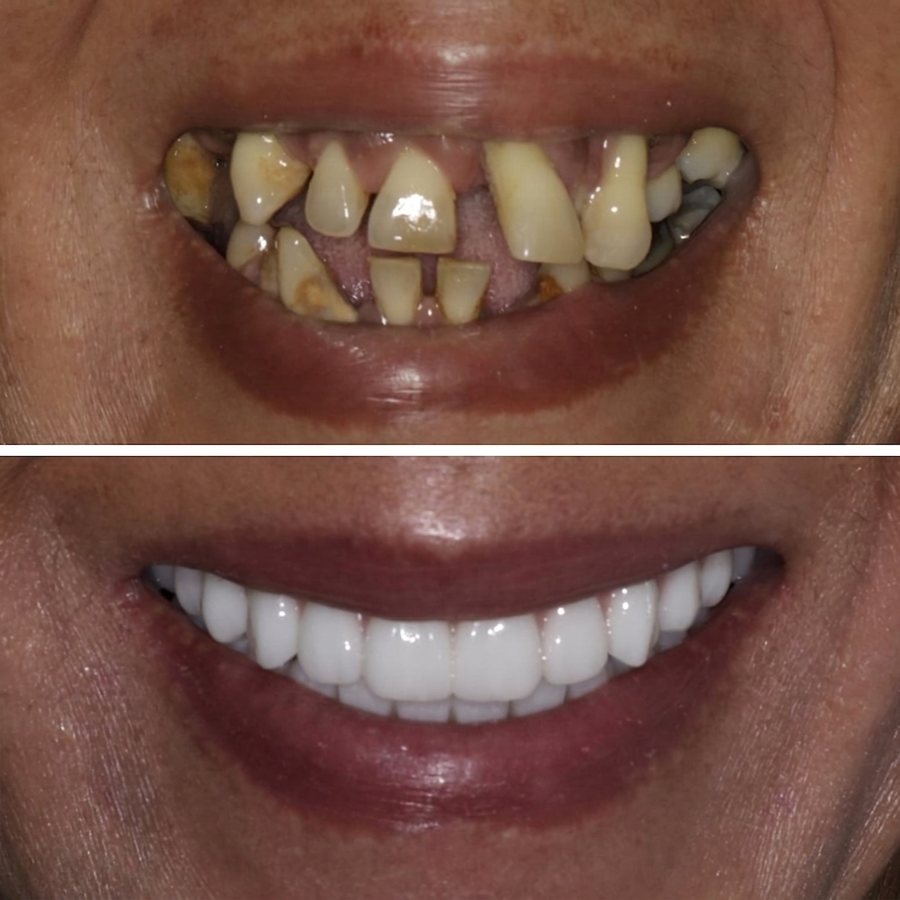 Antes y después de un caso complejo de implantes