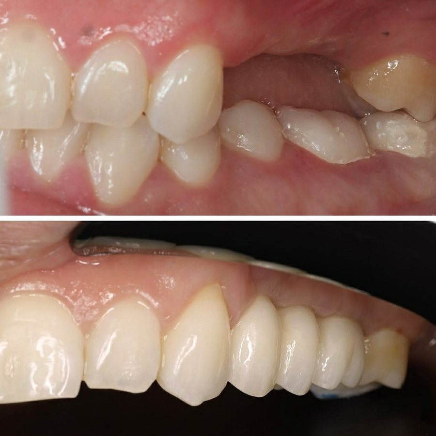 Antes y después de implantes en dientes posteriores