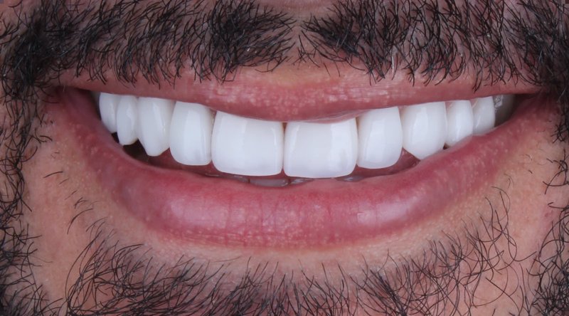 Sonrisa perfecta con carillas de cerámica