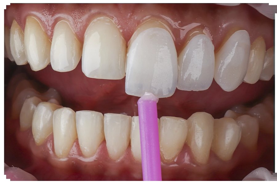 Diseño de sonrisa en cerómero
