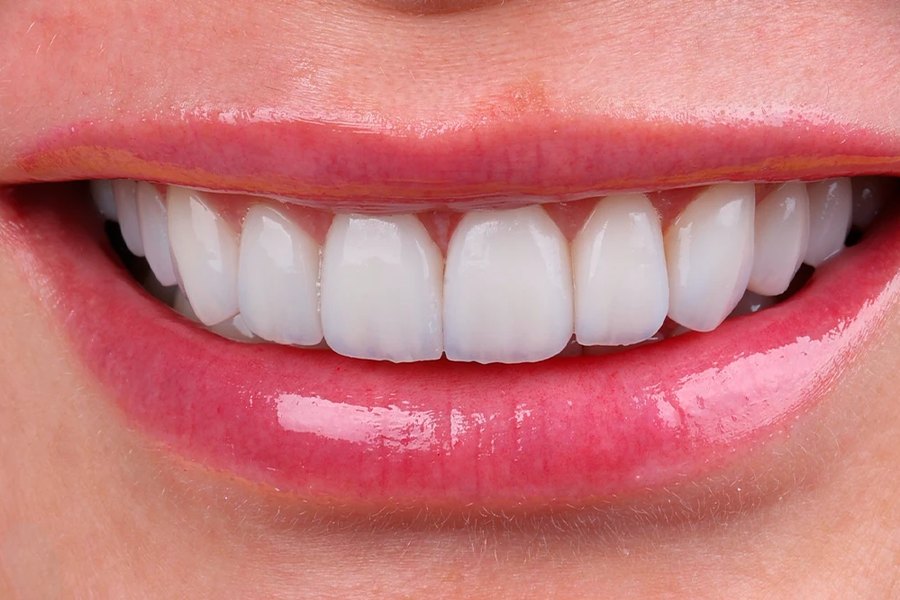 Diseño de sonrisa en resina