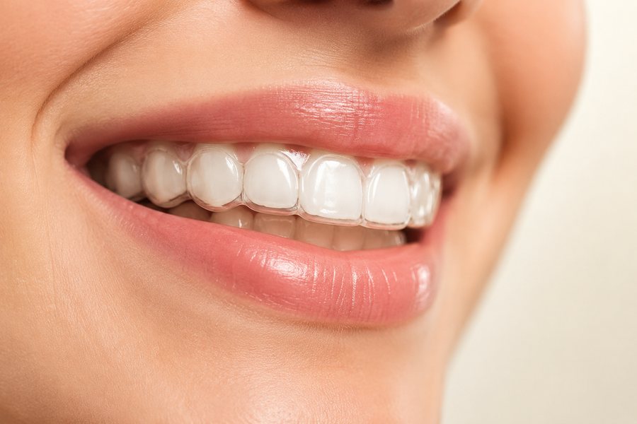 Alineadores transparentes Invisalign