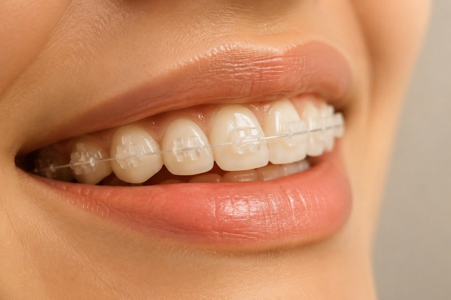 Brackets de zafiro transparentes